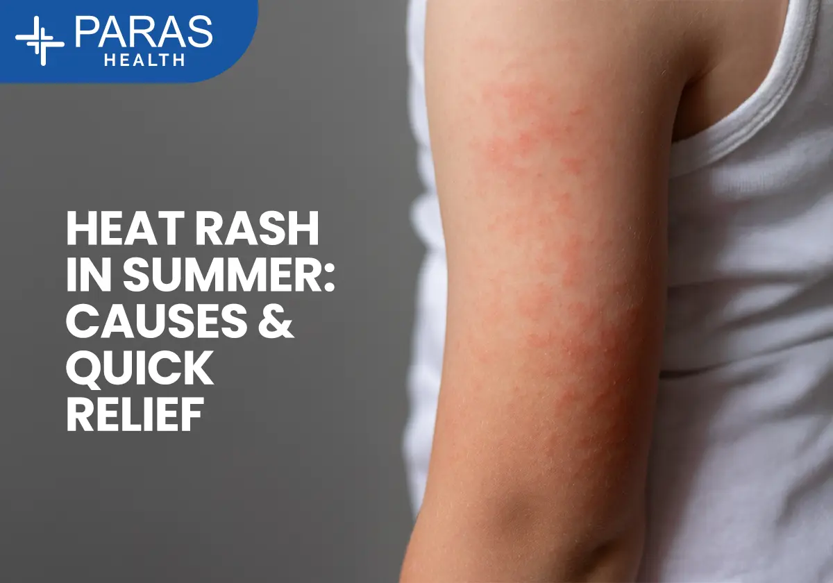 Heat Rash (Prickly Heat): Causes, Symptoms, Treatment & Prevention in Summer